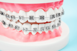 types-of-braces-1