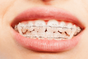 types-of-braces-2