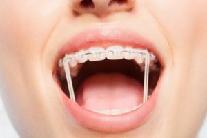 types-of-braces-4