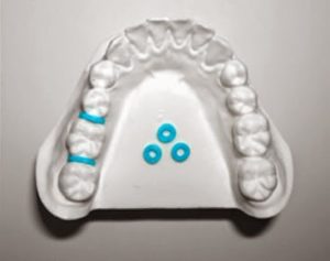 types-of-braces-5