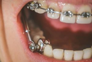 types-of-braces-6